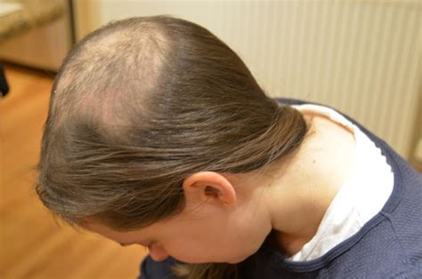 Trichotillomania (TTM or Trich) in children is a condition where the child repetitively pulls out their own hair, resulting in noticeable hair loss. This hair pulling and the associated hair loss causes considerable distress or impairment in daily functioning (for the child or parent). Pulling hair excessively can sometimes result …